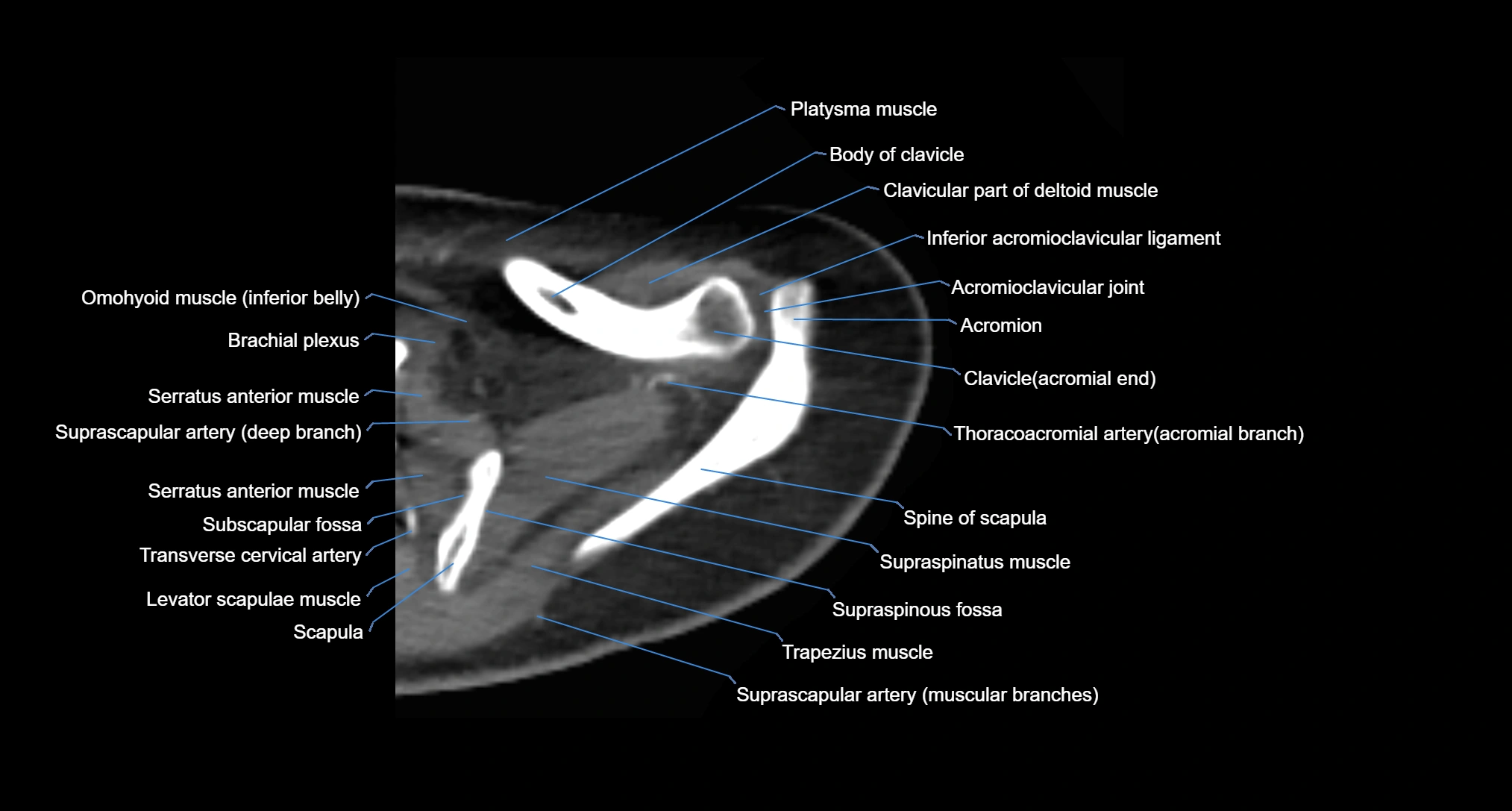 CT Shoulder axial cross sectional anatomy labelled radiology image -00015.webp